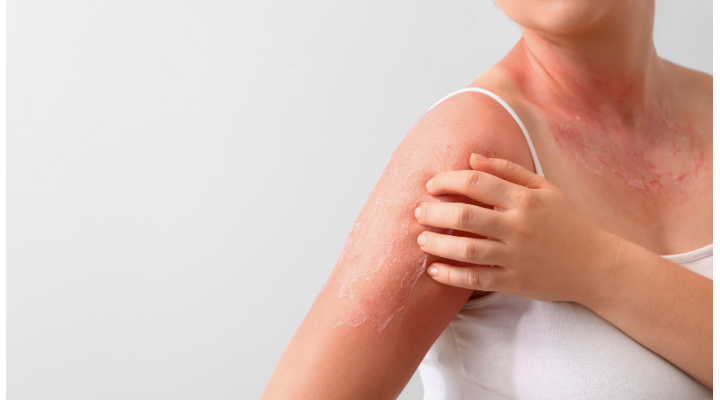 Eritema solare: consigli per prevenirlo e attenuarlo